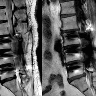 How Neurological Surgeons Handle Complex Spine Tumors