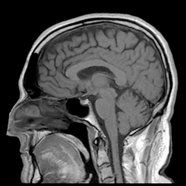 How Neuroradiology Advances in Imaging for Parkinson’s Disease