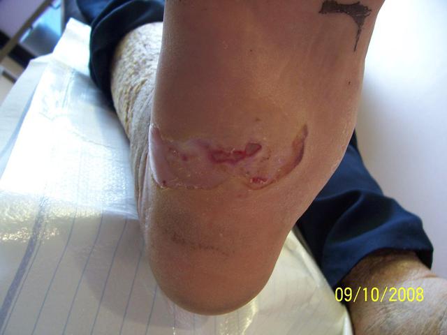 How To Care for Diabetic Wounds