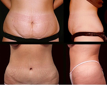 Recovering From a Tummy Tuck