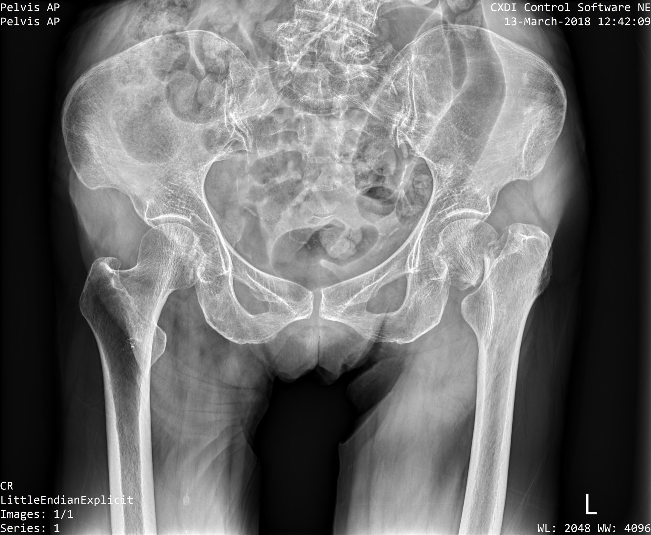 What To Know About Kyphoplasty for Osteoporotic Fractures