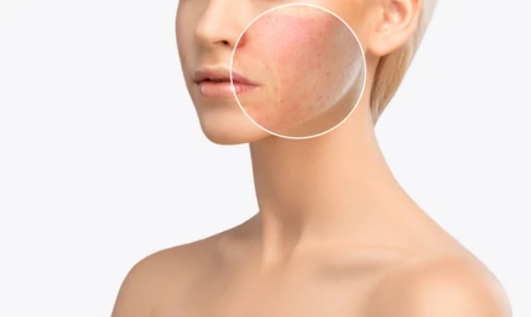 How Does Microneedling Help Sun-damaged Skin?