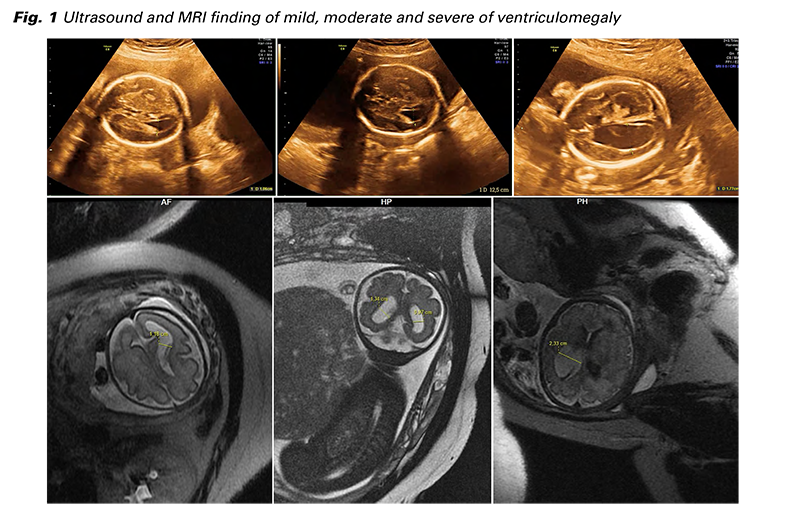 Differences in Ultrasound vs. MRI Results in Diagnosing Your Condition