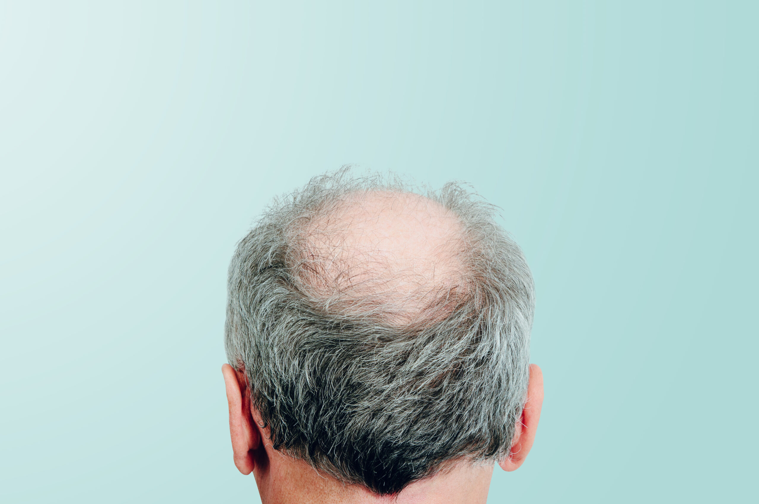 What Causes Hair Loss?
