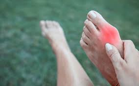 4 Tips for Managing Bunions