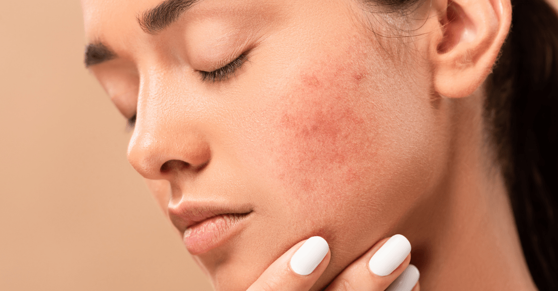 Acne Treatment: The Impact of Hormones on Acne and Natural Solutions