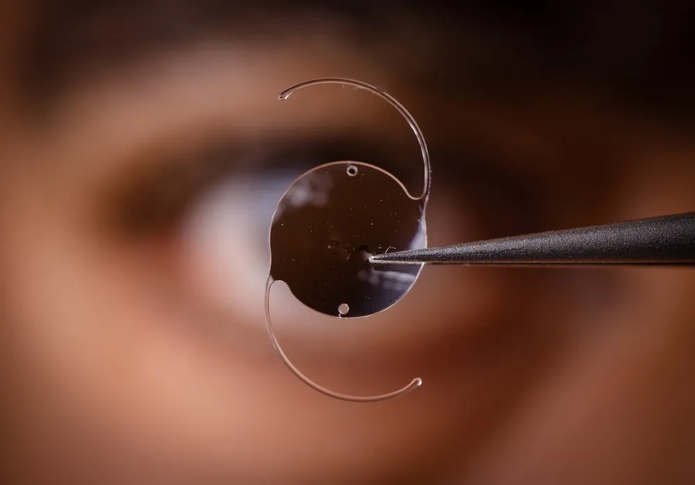 Choosing the Right Time for Cataract Surgery: Factors to Consider