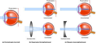 Exploring the Safety and Efficacy of Laser Vision Correction