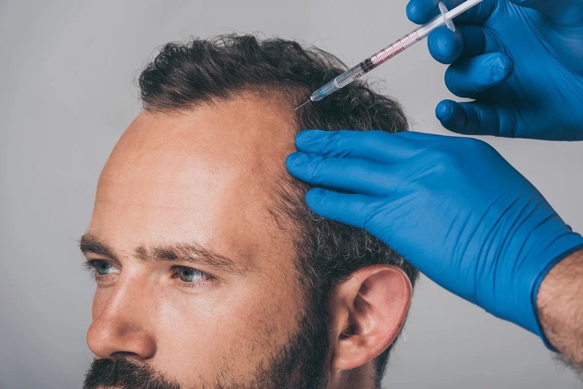 How PRP is A Natural Way to Stimulate Hair Growth