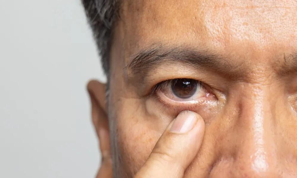 How to Prepare for LASIK Surgery and Ensure a Smooth Recovery Process