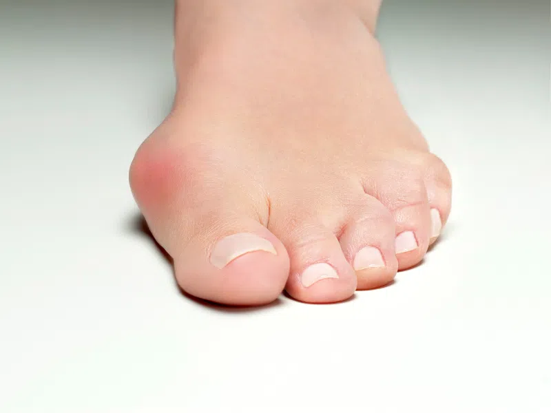 Podiatry Treatments for Bunions: What You Should Know Before Considering Surgery
