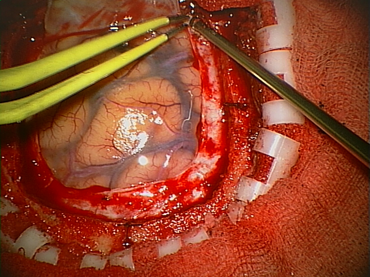 The Benefits of Brain Surgery