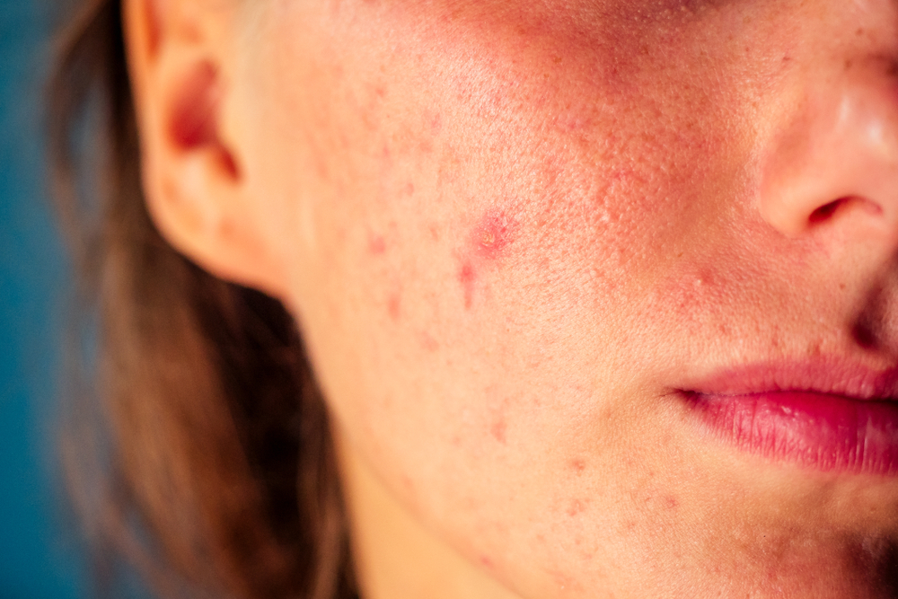 Why You Should Consult a Dermatologist for Persistent Rashes