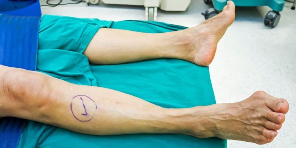 4 Questions To Ask Your Surgeon Before an Ankle Replacement