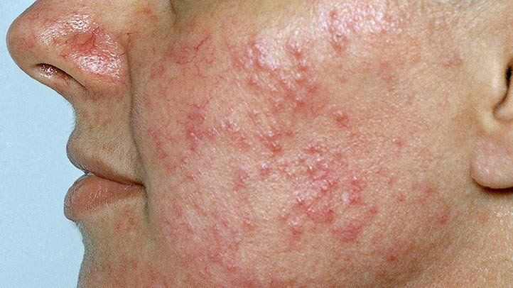 Identifying the Different Types of Skin Rashes