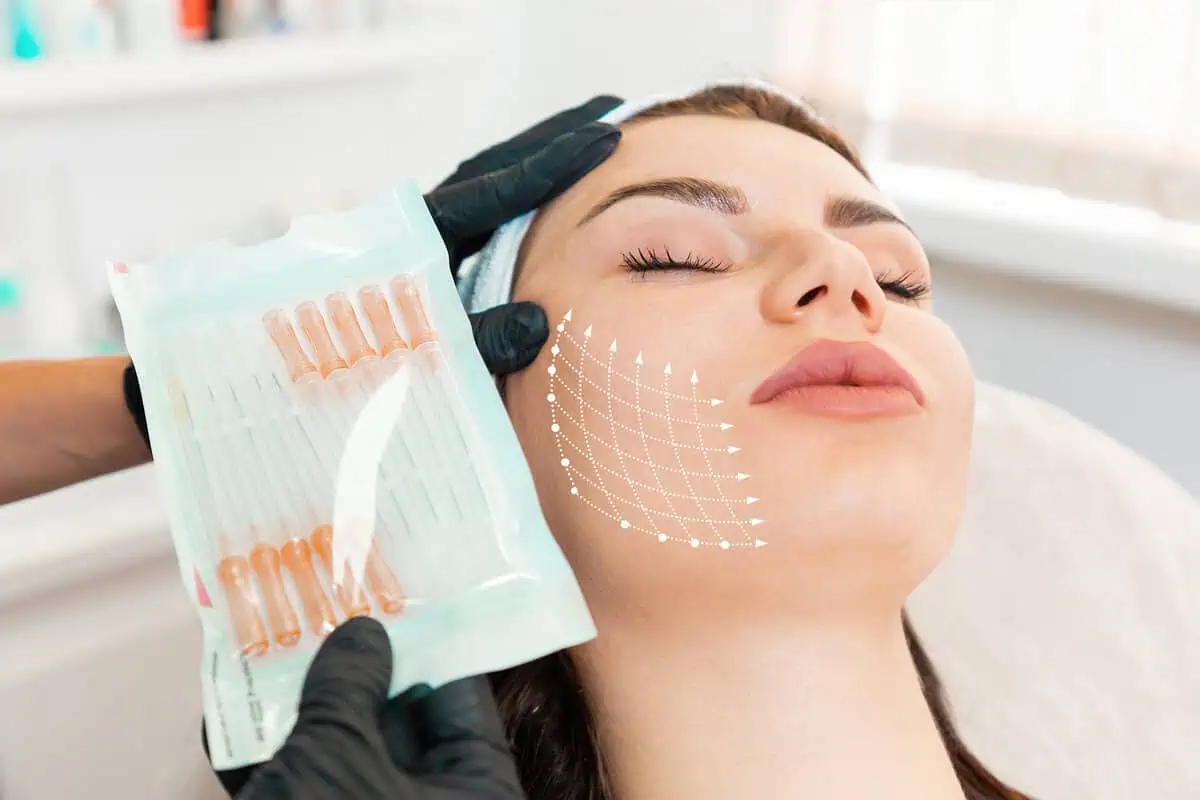 Microneedling for Stretch Marks: What to Expect