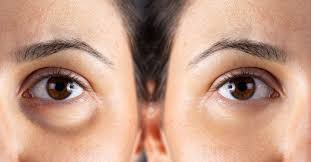 Morpheus8 and Its Anti-aging Benefits