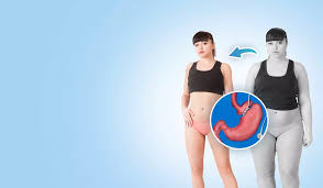 The Importance of Aftercare in Weight Loss Surgery