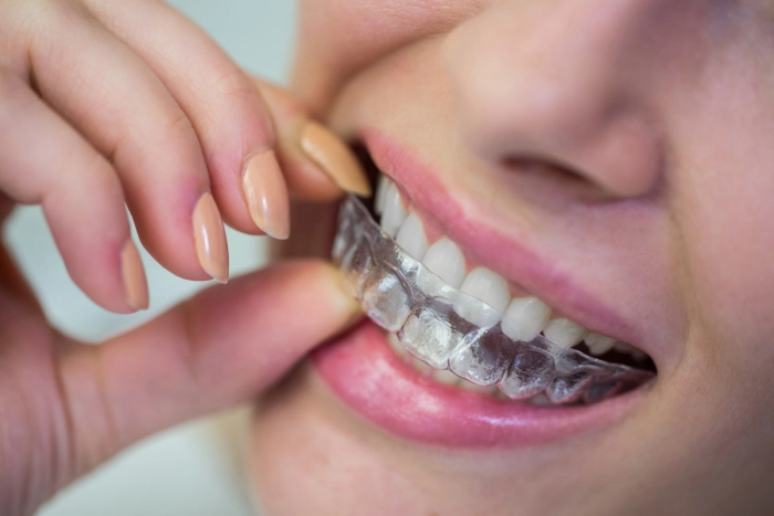 Clear Aligners: Your Guide to Invisible Teeth Straightening