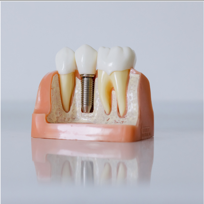 Zirconia Ceramic Implants for Natural-Looking and Durable Tooth Replacement